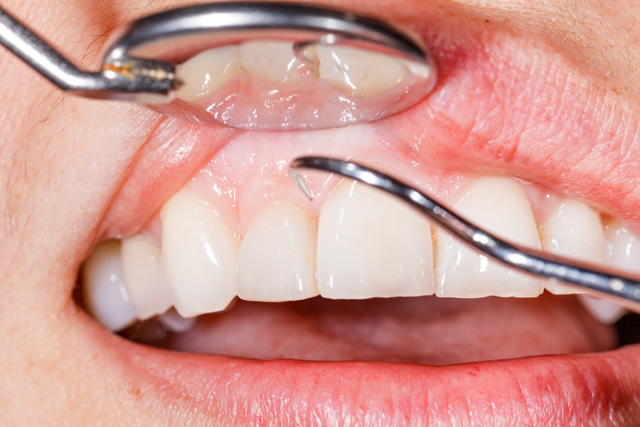 Profound Cleaning Can Give Longer Life to Teeth and Gums