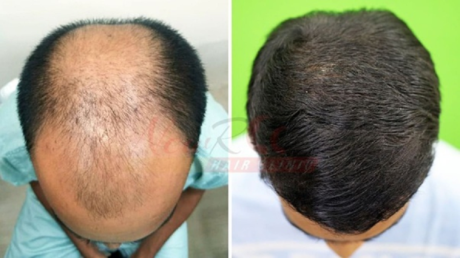 Things to Avoid After a Hair Transplant
